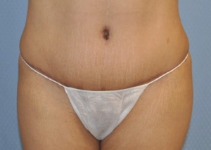 tummy-tuck-abdominoplasty-plastic-surgery-rancho-cucamonga-woman-after-front-dr-maan-kattash