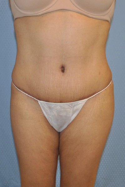 tummy-tuck-abdominoplasty-plastic-surgery-rancho-cucamonga-woman-after-front-dr-maan-kattash