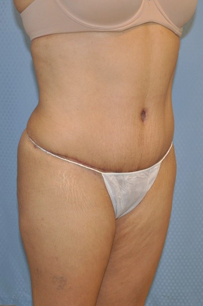 tummy-tuck-abdominoplasty-plastic-surgery-rancho-cucamonga-woman-after-oblique-dr-maan-kattash