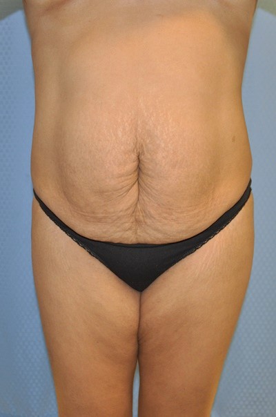 tummy-tuck-abdominoplasty-plastic-surgery-rancho-cucamonga-woman-before-front-dr-maan-kattash
