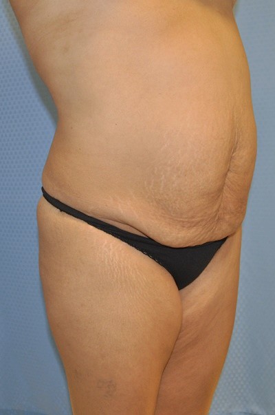 tummy-tuck-abdominoplasty-plastic-surgery-rancho-cucamonga-woman-before-oblique-dr-maan-kattash