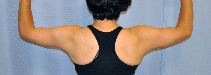 brachioplasty-arm-lift-surgery-loose-floppy-skin-beverly-hills-woman-after-back-dr-maan-kattash