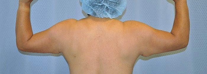 brachioplasty-arm-lift-surgery-loose-floppy-skin-beverly-hills-woman-before-back-dr-maan-kattash