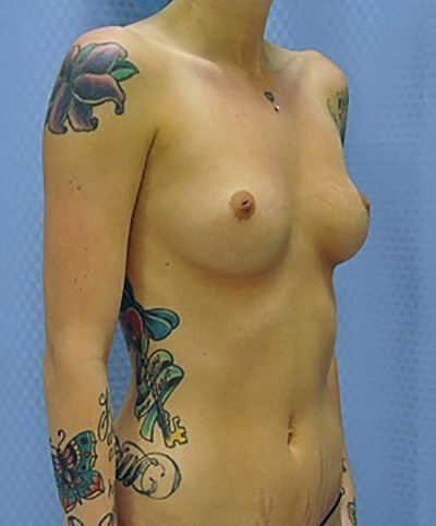 breast-enlargement-augmentation-plastic-surgery-upland-woman-before-oblique-dr-maan-kattash