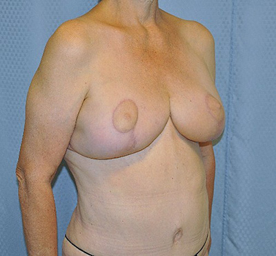 breast-lift-plastic-surgery-irvine-upland-woman-after-right-obdr-maan-kattash