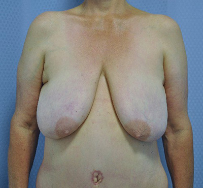 breast-lift-plastic-surgery-irvine-upland-woman-before-front-dr-maan-kattash