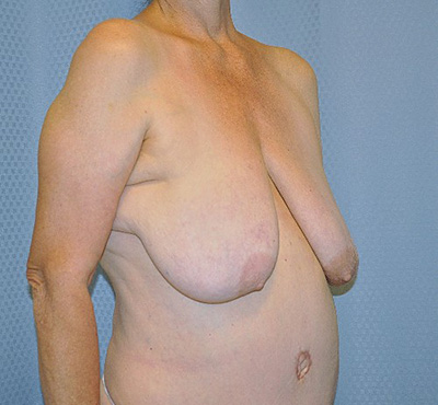 breast-lift-plastic-surgery-irvine-upland-woman-before-right-ob-dr-maan-kattash