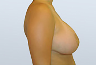 breast-lift-plastic-surgery-mastopexy-rancho-cucamonga-woman-after-side-dr-maan-kattash