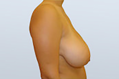 breast-lift-plastic-surgery-mastopexy-rancho-cucamonga-woman-before-side-dr-maan-kattash