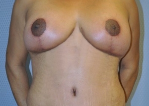 breast-reduction-plastic-surgery-rancho-cucamonga-woman-after-front-dr-maan-kattash