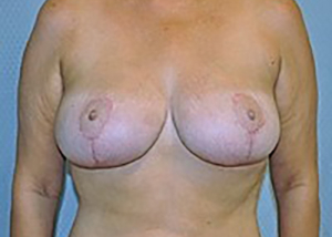 breast-reduction-plastic-surgery-upland-woman-after-front-dr-maan-kattash