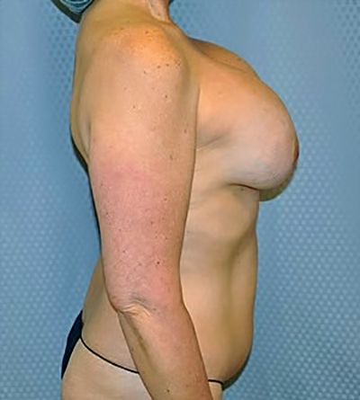 breast-revision-surgery-implants-los-angeles-woman-before-side-dr-maan-kattash