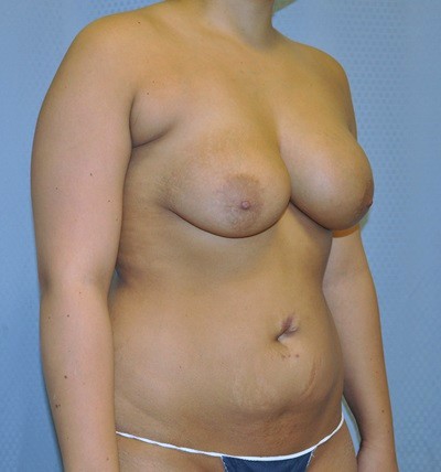 breast-revision-surgery-implants-scarring-los-angeles-woman-before-right-dr-maan-kattash