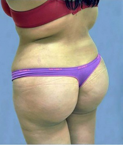 buttock-augmentation-brazilian-butt-lift-claremont-woman-after-back-dr-maan-kattash