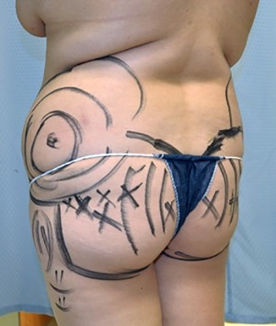 buttock-augmentation-brazilian-butt-lift-claremont-woman-after-side-dr-maan-kattash