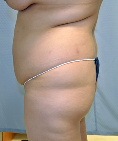 buttock-augmentation-brazilian-butt-lift-claremont-woman-before-side-dr-maan-kattash