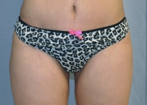 buttock-augmentation-brazilian-butt-lift-upland-woman-after-front-dr-maan-kattash