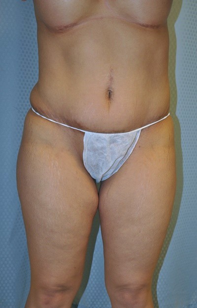 buttock-augmentation-brazilian-butt-lift-upland-woman-before-front-dr-maan-kattash