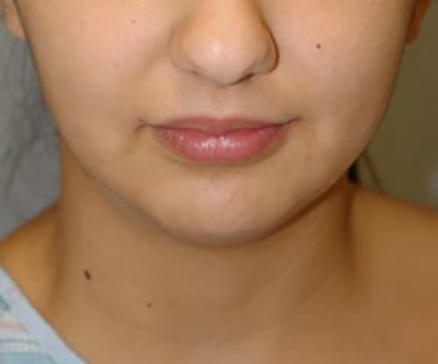 chin-augmentation-cheek-plastic-surgery-beverly-hills-woman-after-front-dr-maan-kattash-2