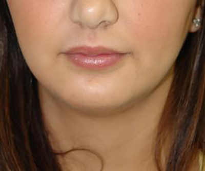 chin-augmentation-cheek-plastic-surgery-beverly-hills-woman-after-front-dr-maan-kattash2-2