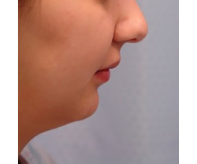 chin-augmentation-cheek-plastic-surgery-beverly-hills-woman-before-side-dr-maan-kattash