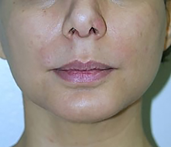 chin-augmentation-cheek-plastic-surgery-los-angeles-woman-after-front-dr-maan-kattash-2