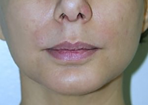 chin-augmentation-cheek-plastic-surgery-los-angeles-woman-after-side-dr-maan-kattash2-2