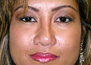 chin-augmentation-cheek-plastic-surgery-rancho-cucamonga-woman-after-front-dr-maan-kattash-2