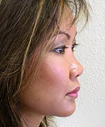 chin-augmentation-cheek-plastic-surgery-rancho-cucamonga-woman-after-side-dr-maan-kattash-2