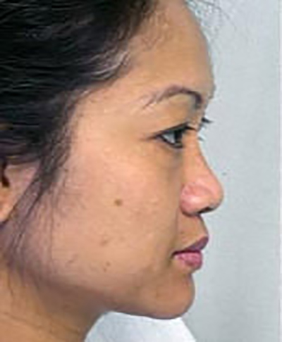 chin-augmentation-cheek-plastic-surgery-rancho-cucamonga-woman-before-side-dr-maan-kattash-2