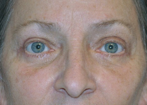 eyelid-lift-blepharoplasty-cosmetic-surgery-rancho-cucamonga-woman-after-front-dr-maan-kattash