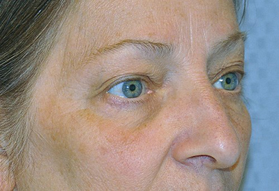 eyelid-lift-blepharoplasty-cosmetic-surgery-rancho-cucamonga-woman-before-right-ob-dr-maan-kattash