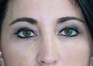 eyelid-lift-blepharoplasty-plastic-surgery-beverly-hills-woman-after-front-dr-maan-kattash