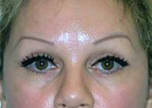 eyelid-lift-blepharoplasty-plastic-surgery-claremont-woman-after-front-dr-maan-kattash