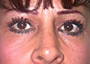 eyelid-lift-blepharoplasty-plastic-surgery-inland-empire-woman-after-front-dr-maan-kattash-2