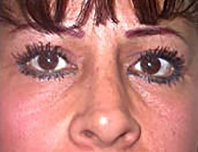 eyelid-lift-blepharoplasty-plastic-surgery-inland-empire-woman-after-front-dr-maan-kattash-2
