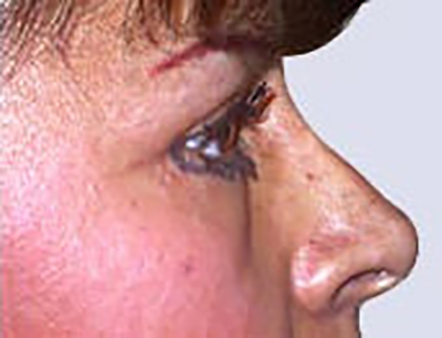 eyelid-lift-blepharoplasty-plastic-surgery-inland-empire-woman-after-side-dr-maan-kattash-2