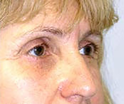 eyelid-lift-blepharoplasty-plastic-surgery-irvine-after-oblique-dr-maan-kattash