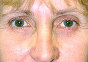 eyelid-lift-blepharoplasty-plastic-surgery-irvine-woman-after-front-dr-maan-kattash