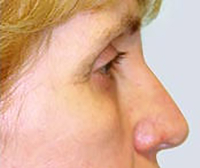 eyelid-lift-blepharoplasty-plastic-surgery-irvine-woman-after-side-dr-maan-kattash