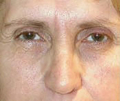 eyelid-lift-blepharoplasty-plastic-surgery-irvine-woman-before-front-dr-maan-kattash