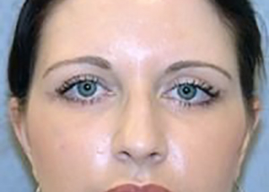 eyelid-lift-blepharoplasty-plastic-surgery-los-angeles-woman-after-front-dr-maan-kattash