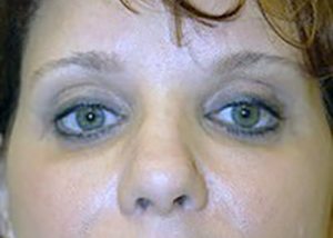 eyelid-lift-blepharoplasty-plastic-surgery-ontario-woman-after-front-dr-maan-kattash