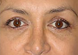 eyelid-lift-blepharoplasty-plastic-surgery-orange-county-woman-after-front-dr-maan-kattas