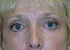 eyelid-lift-blepharoplasty-plastic-surgery-rancho-cucamonga-woman-after-front-dr-maan-kattash