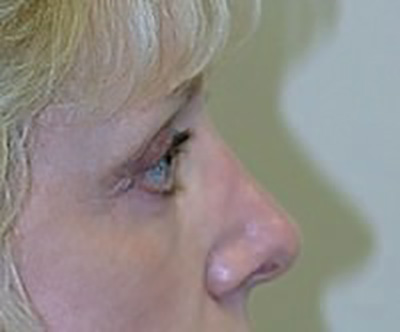 eyelid-lift-blepharoplasty-plastic-surgery-rancho-cucamonga-woman-after-side-dr-maan-kattash