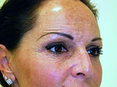 eyelid-lift-blepharoplasty-plastic-surgery-redlands-after-oblique-dr-maan-kattash