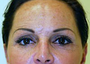eyelid-lift-blepharoplasty-plastic-surgery-redlands-woman-after-front-dr-maan-kattash