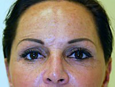 eyelid-lift-blepharoplasty-plastic-surgery-redlands-woman-after-front-dr-maan-kattash