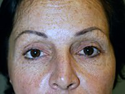 eyelid-lift-blepharoplasty-plastic-surgery-redlands-woman-before-front-dr-maan-kattash